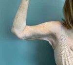 Arm Lift Before & After Pictures