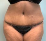 Abdominoplasty Before & After Pictures