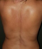 Liposuction Before & After Pictures