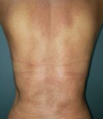 Liposuction Before & After Pictures