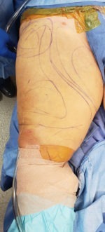 Liposuction Before & After Pictures