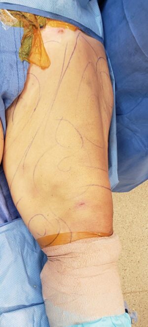 Liposuction Before & After Pictures