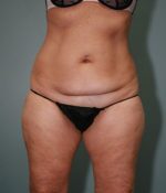 Liposuction Before & After Pictures