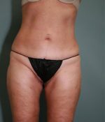 Liposuction Before & After Pictures