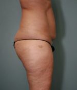 Liposuction Before & After Pictures