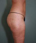 Liposuction Before & After Pictures