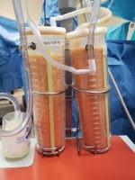 Liposuction Before & After Pictures