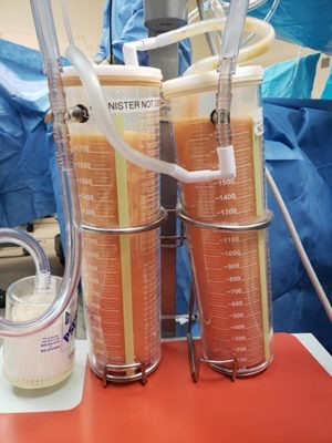 Liposuction Before & After Pictures