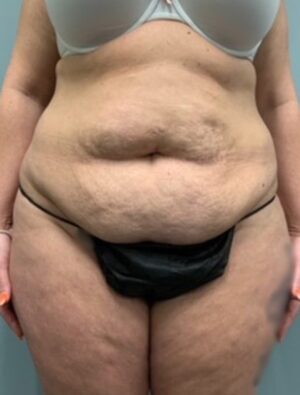 Abdominoplasty Before & After Pictures