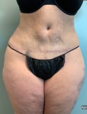 Abdominoplasty Before & After Pictures