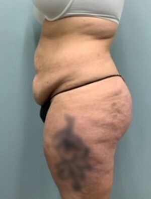 Abdominoplasty Before & After Pictures