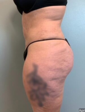 Abdominoplasty Before & After Pictures