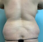 Liposuction Before & After Pictures