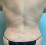 Liposuction Before & After Pictures