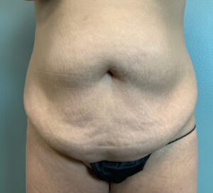 Abdominoplasty Before & After Pictures