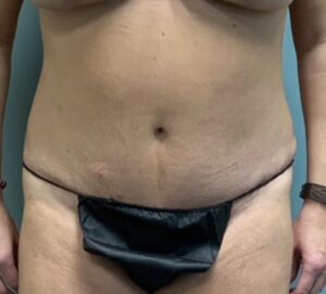 Abdominoplasty Before & After Pictures