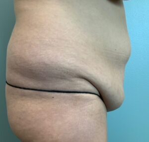 Abdominoplasty Before & After Pictures