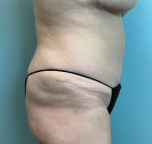 Abdominoplasty Before & After Pictures