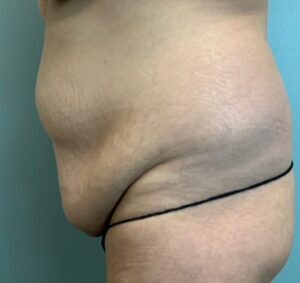 Abdominoplasty Before & After Pictures