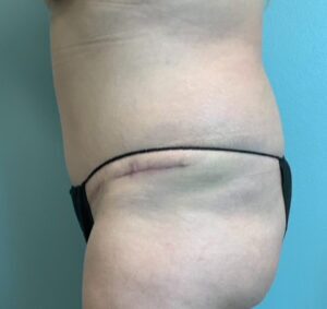 Abdominoplasty Before & After Pictures