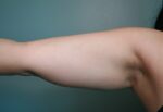 Liposuction Before & After Pictures