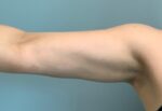 Liposuction Before & After Pictures