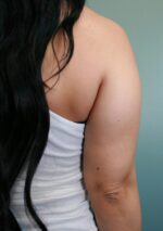 Liposuction Before & After Pictures