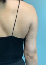 Liposuction Before & After Pictures