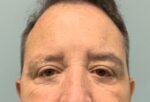 Blepharoplasty Before & After Pictures