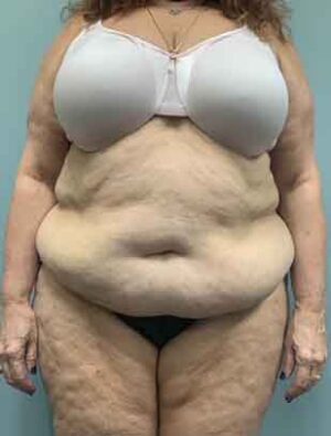 Liposuction Before & After Pictures