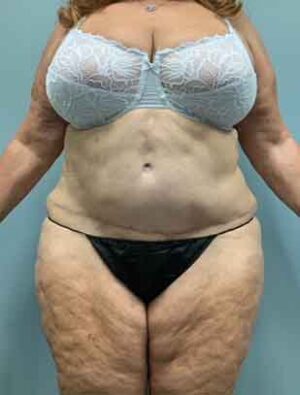 Liposuction Before & After Pictures