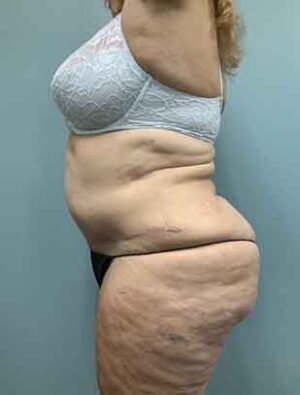 Liposuction Before & After Pictures