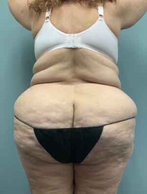 Liposuction Before & After Pictures