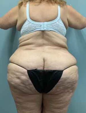 Liposuction Before & After Pictures