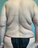 Back Lift Before & After Pictures