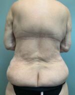 Back Lift Before & After Pictures
