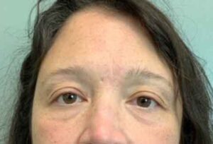 Blepharoplasty Before & After Pictures
