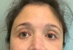 Blepharoplasty Before & After Pictures