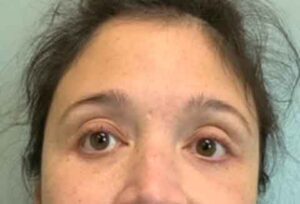 Blepharoplasty Before & After Pictures