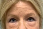 Blepharoplasty Before & After Pictures