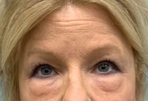 Blepharoplasty Before & After Pictures