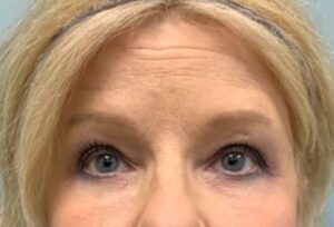 Blepharoplasty Before & After Pictures