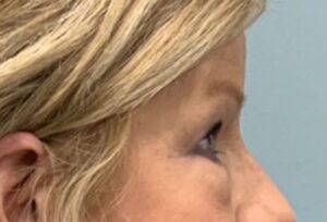 Blepharoplasty Before & After Pictures