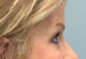 Blepharoplasty Before & After Pictures