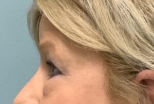Blepharoplasty Before & After Pictures