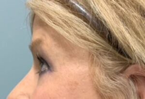 Blepharoplasty Before & After Pictures