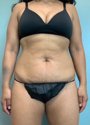 Abdominoplasty Before & After Pictures