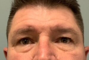 Blepharoplasty Before & After Pictures