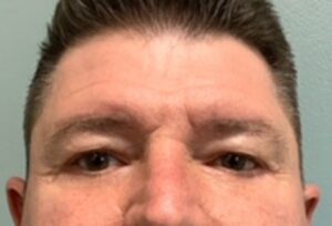 Blepharoplasty Before & After Pictures