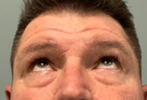 Blepharoplasty Before & After Pictures